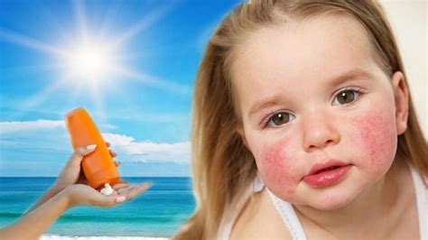 güneş kremi alerjisi nasıl geçer